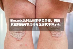 Bimzelx头对头III期研究告捷，斑块状银屑病关节炎指标显著优于Skyrizi