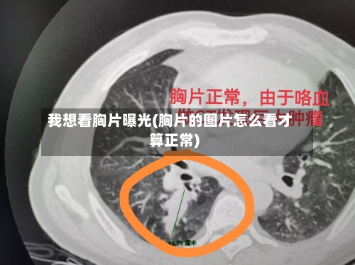 我想看胸片曝光(胸片的图片怎么看才算正常)-第2张图片