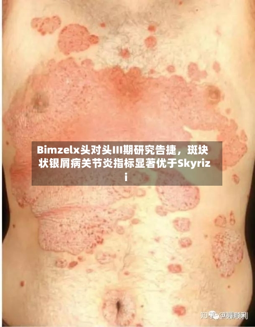 Bimzelx头对头III期研究告捷，斑块状银屑病关节炎指标显著优于Skyrizi-第2张图片