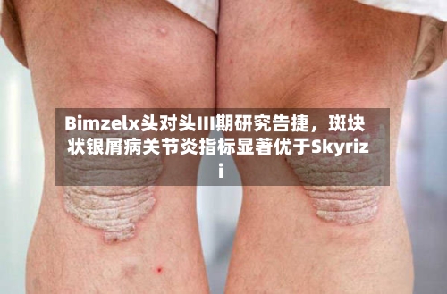 Bimzelx头对头III期研究告捷，斑块状银屑病关节炎指标显著优于Skyrizi-第1张图片
